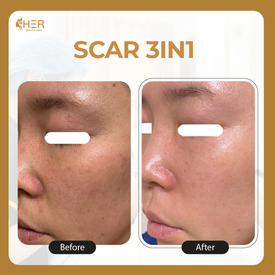 Scar 3in1: Kết hợp 3 phương pháp tách đáy sẹo, mcroneeding, Peel